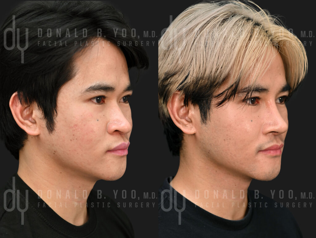 Male Asian Rhinoplasty before and after with DCF and rib cartilage 