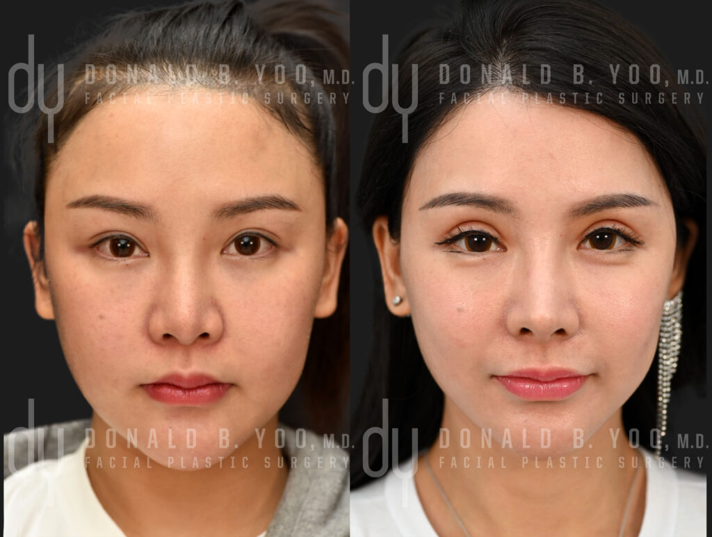 Before and after revision rhinoplasty with unified rib cartilage grafts and diced cartilage fascia to create a more refined and balanced nose.