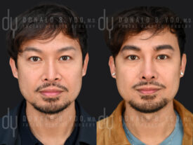 SURGICAL :: RHINOPLASTY<br> Revision Rhinoplasty with Rib Cartilage and DCF