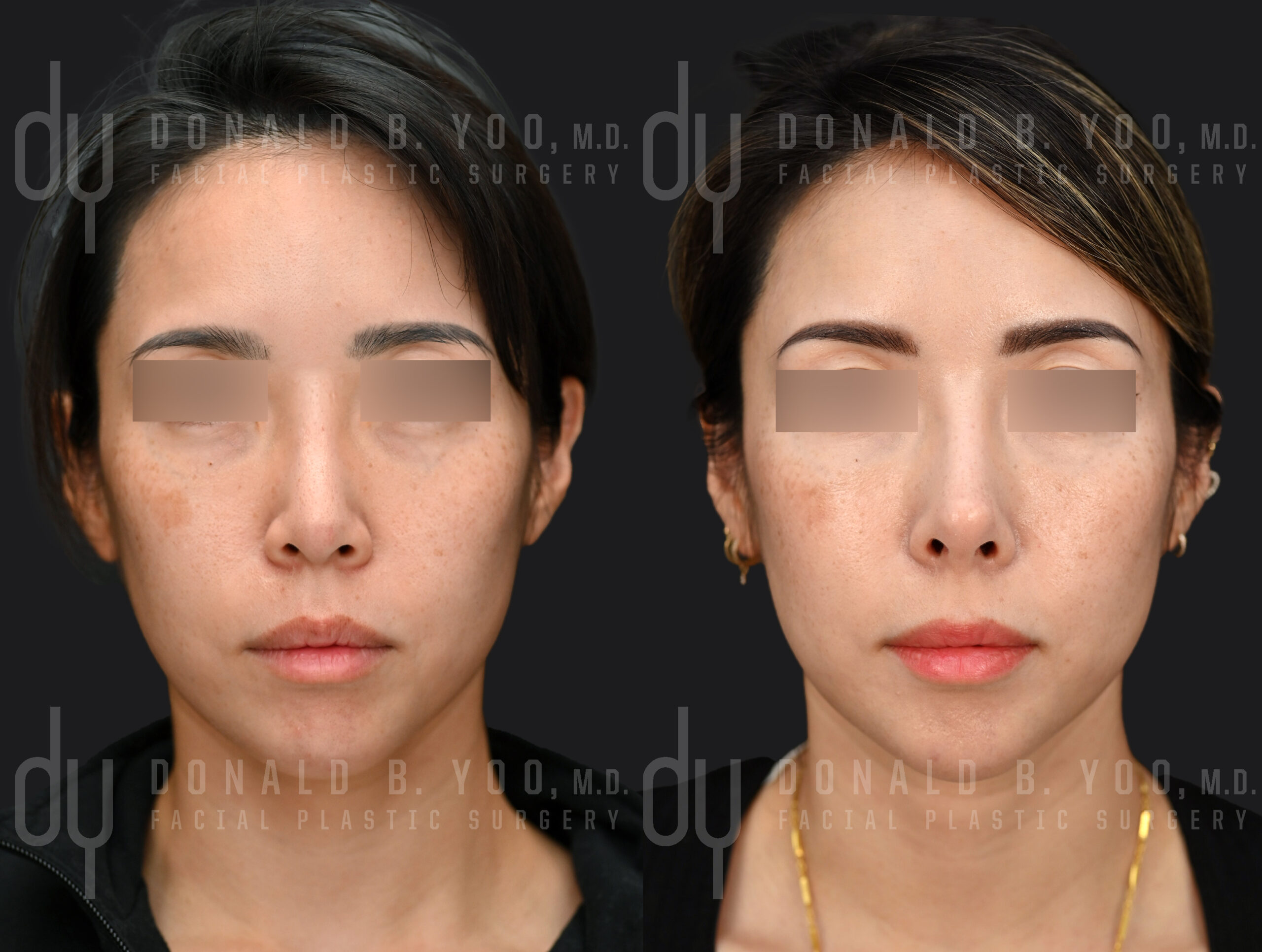 SURGICAL :: RHINOPLASTY<br>Asian Rhinoplasty