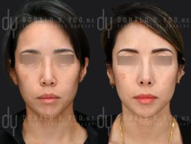 SURGICAL :: RHINOPLASTY<br>Asian Rhinoplasty