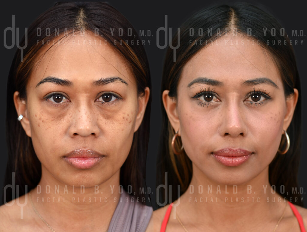 Asian rhinoplasty with rib cartilage, DCF, and alarplasty before and after — Beverly Hills facial plastic surgeon Dr. Donald Yoo