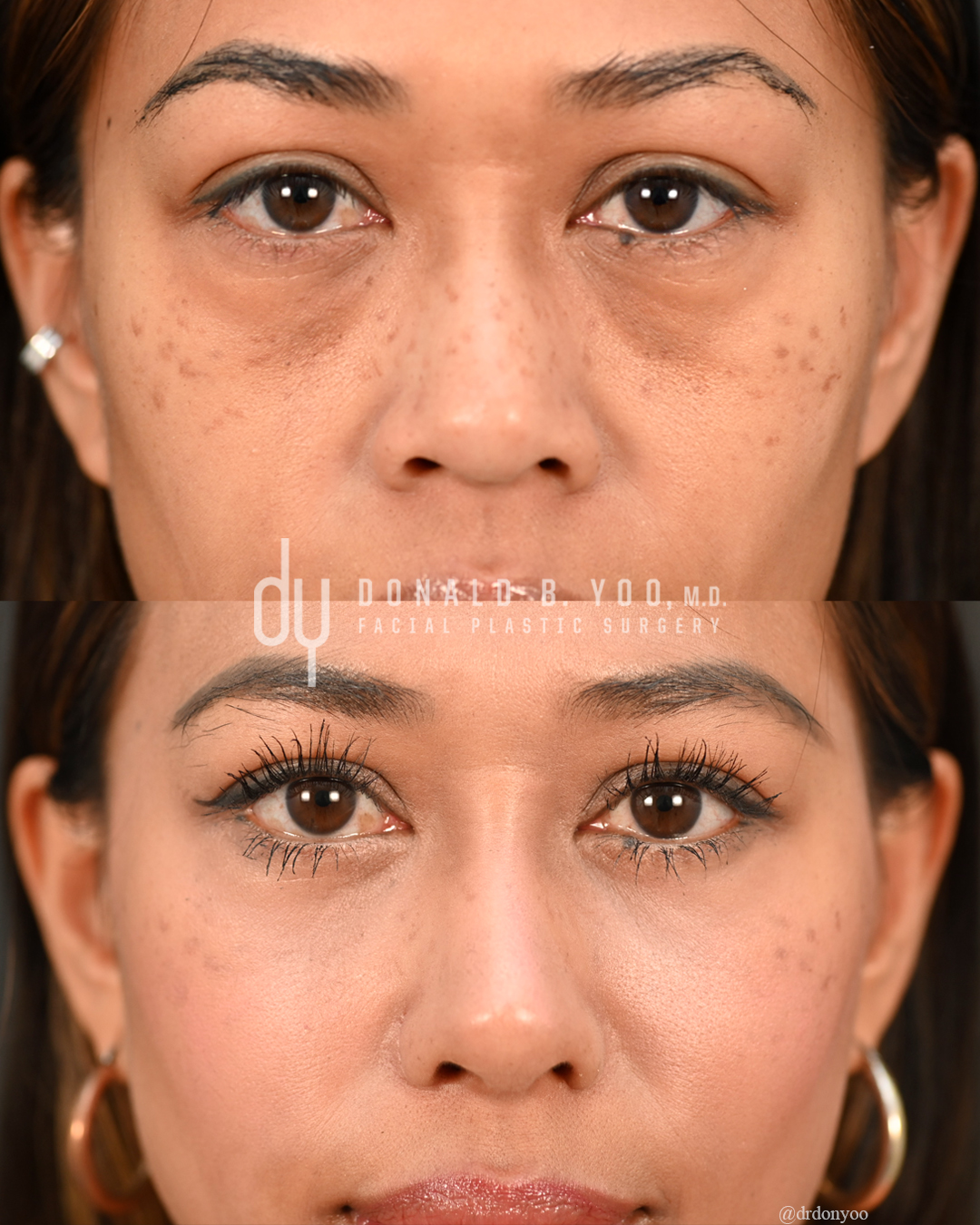 SURGICAL :: BLEPHAROPLASTY<br>Lower Blepharoplasty with Fat Repositioning