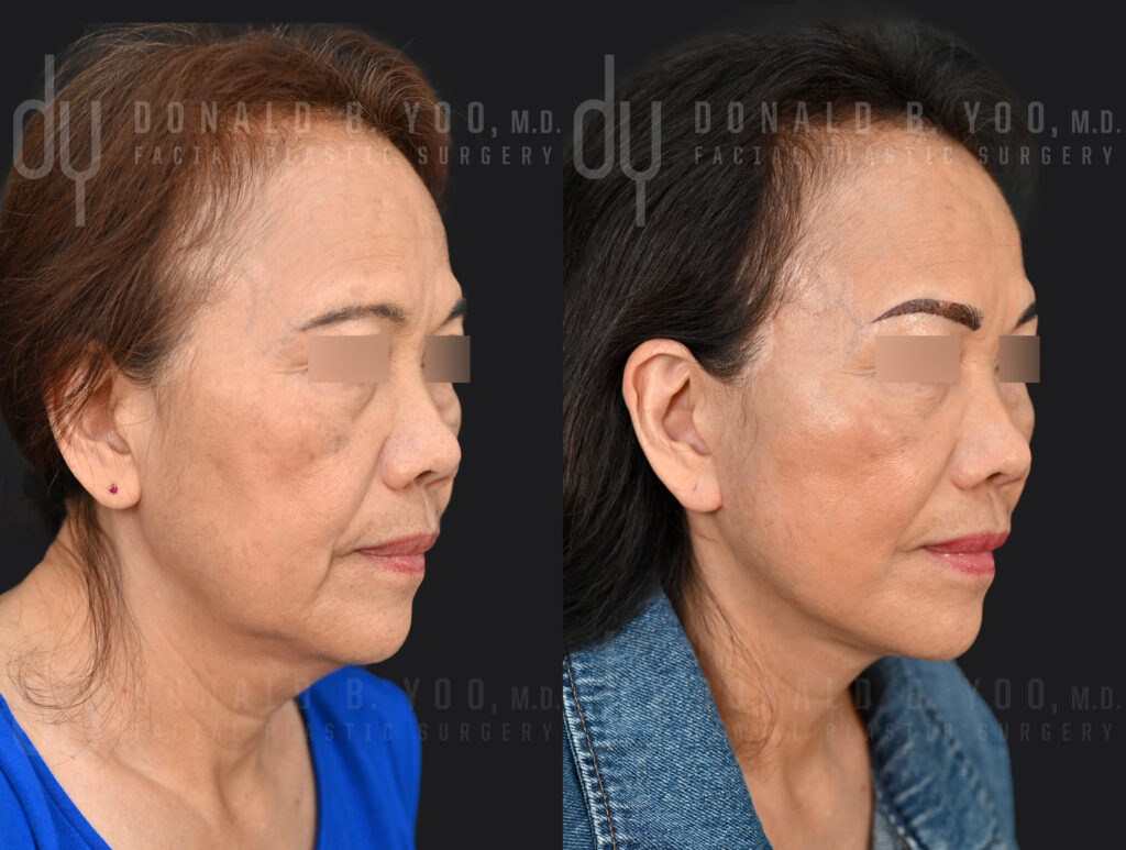 Deep plane facelift with neck lift before and after, 6 months — Beverly Hills facial plastic surgeon Dr. Donald Yoo