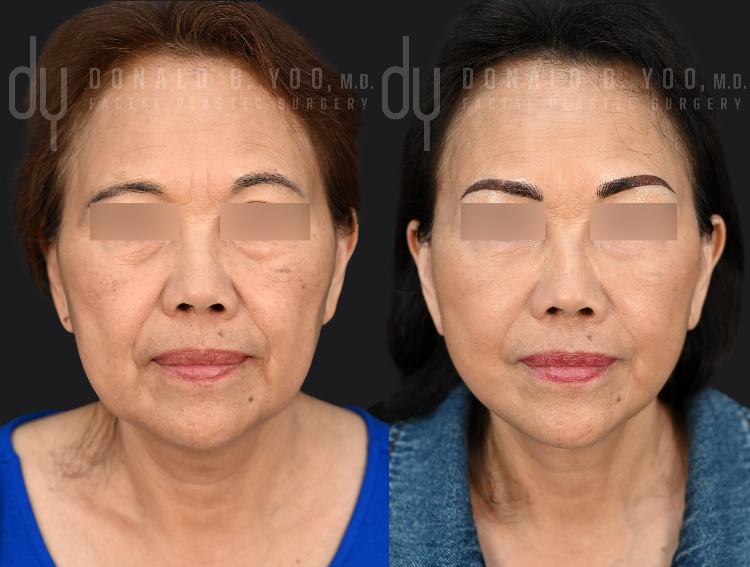 SURGICAL :: FACELIFT<br>Deep Plane Facelift