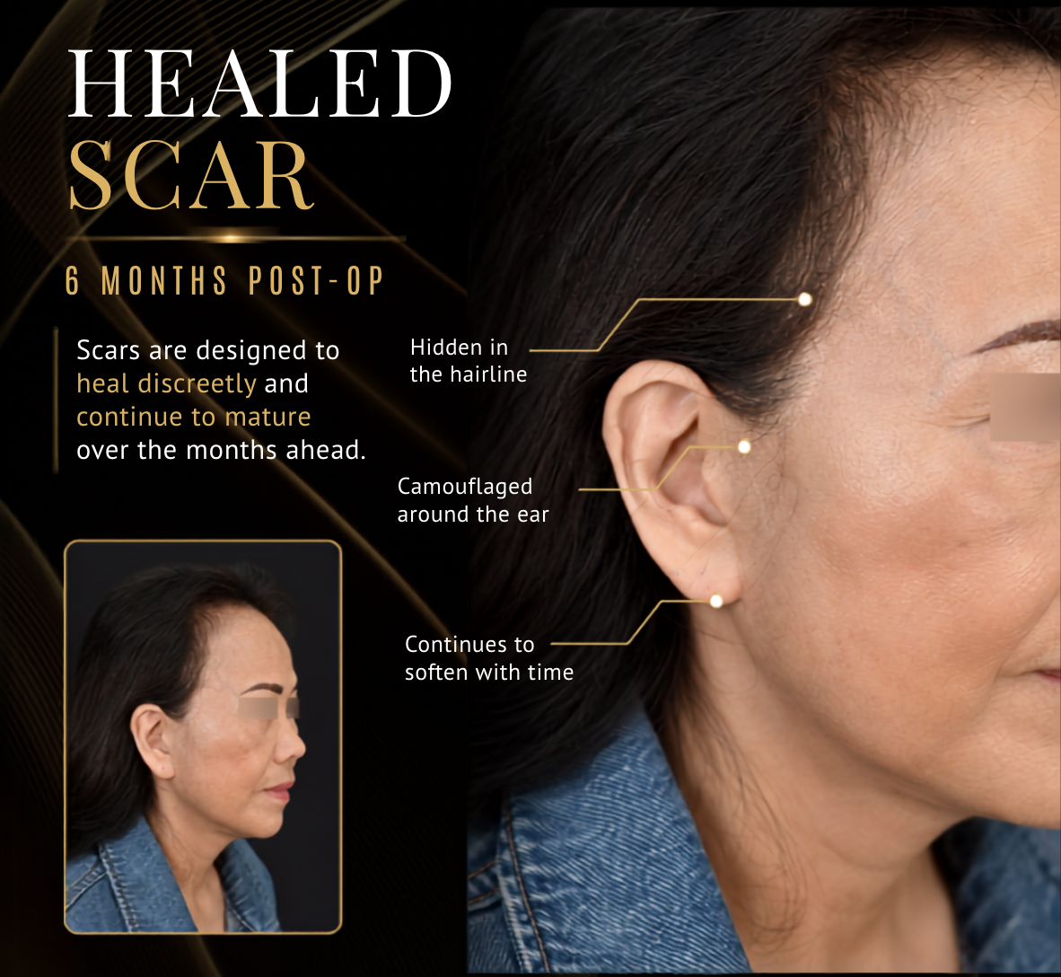 SURGICAL :: FACELIFT<br>Deep Plane Facelift