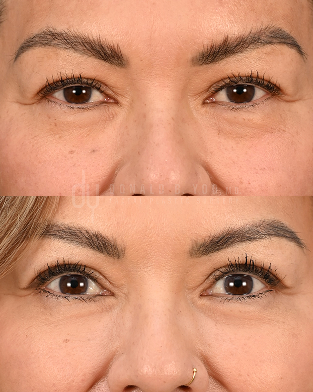 SURGICAL :: BLEPHAROPLASTY<br> Upper Blepharoplasty and Browlift