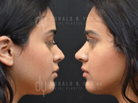 Revision rhinoplasty with rib cartilage and diced cartilage fascia (DCF)