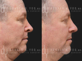 Revision rhinoplasty with rib cartilage