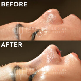 Revision rhinoplasty with rib cartilage, diced cartilage fascia (DCF) and silicone implant removal