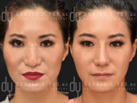 Asian Rhinoplasty with rib cartilage and diced cartilage fascia (DCF)