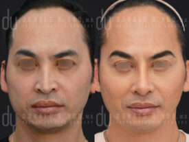 Male rhinoplasty with rib cartilage and diced cartilage fascia (DCF)