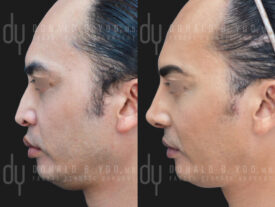 Revision rhinoplasty with rib cartilage, diced cartilage fascia (DCF) and silicone implant removal