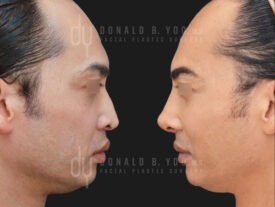 Revision Asian Rhinoplasty with rib cartilage and diced cartilage fascia (DCF)