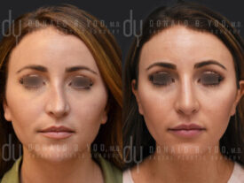 Revision rhinoplasty with rib cartilage