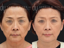 Deep plane facelift