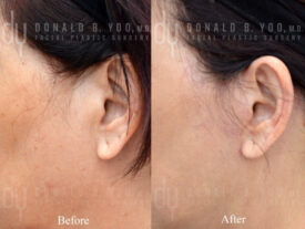 Deep plane facelift