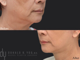 Deep plane facelift