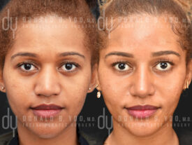 Primary rhinoplasty and alarplasty