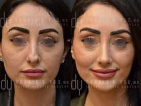 Revision rhinoplasty with ear cartilage