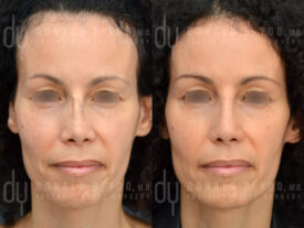 Revision rhinoplasty with rib cartilage and diced cartilage fascia (DCF)