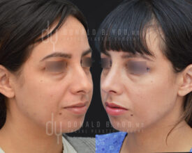 Primary rhinoplasty and septoplasty