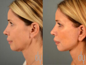 Deep plane facelift