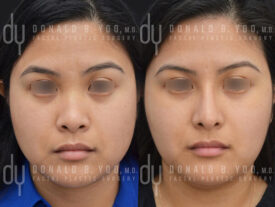 Asian Rhinoplasty with rib cartilage and diced cartilage fascia (DCF)