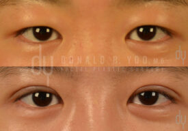 Upper blepharoplasty with Asian double eyelid creation