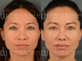 Asian Rhinoplasty with rib cartilage and diced cartilage fascia (DCF)