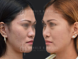 Asian Rhinoplasty with rib cartilage and diced cartilage fascia (DCF)