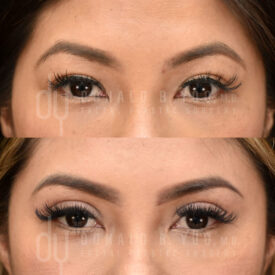 Upper blepharoplasty