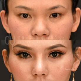 Upper blepharoplasty