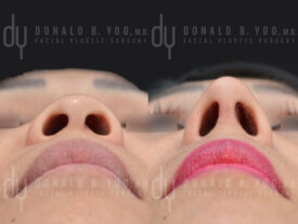Asian rhinoplasty with rib cartilage, diced cartilage fascia (DCF) and alarplasty