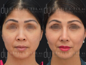 Asian Rhinoplasty with rib cartilage and diced cartilage fascia (DCF)