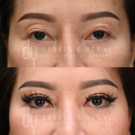 Revision upper blepharoplasty