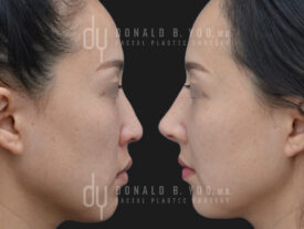 Asian Rhinoplasty with rib cartilage and diced cartilage fascia (DCF)