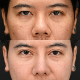 Upper blepharoplasty