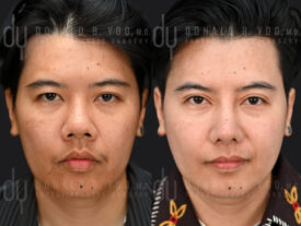 Asian Rhinoplasty with alarplasty