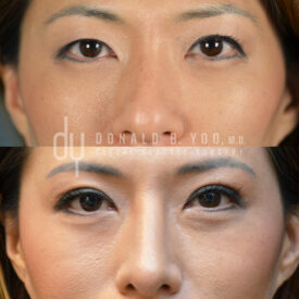 Upper blepharoplasty with Asian double eyelid creation