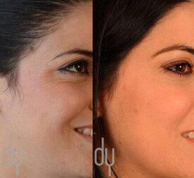 Botox for crow\'s feet