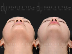 Asian rhinoplasty with rib cartilage, diced cartilage fascia (DCF) and alarplasty