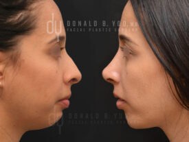 Rhinoplasty and chin augmentation