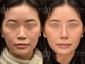 Asian Rhinoplasty with rib cartilage, diced cartilage fascia (DCF) and alarplasty