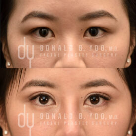 Upper blepharoplasty with Asian double eyelid creation
