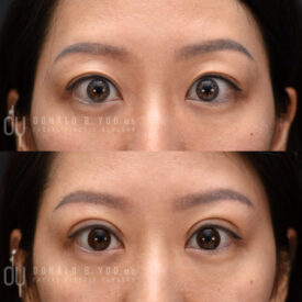 Upper blepharoplasty