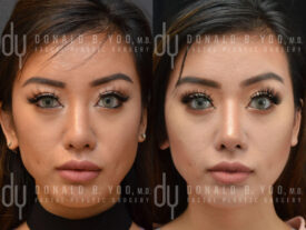 Revision rhinoplasty with rib cartilage and diced cartilage fascia (DCF)