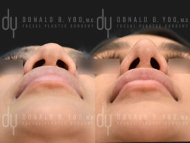 Rhinoplasty with rib cartilage, diced cartilage fascia (DCF) and alarplasty