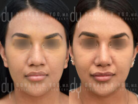 Primary rhinoplasty