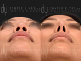 Asian rhinoplasty with rib cartilage, diced cartilage fascia (DCF) and alarplasty